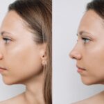 Rhinoplasty-Treatment